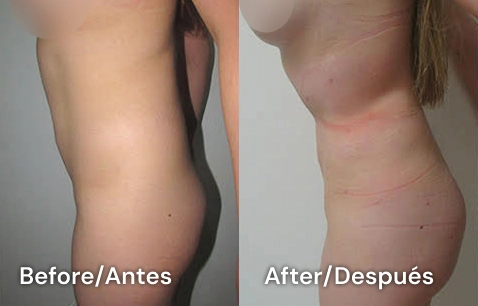 Cirujano plastico en tijuana