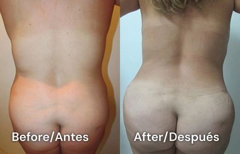 abdominoplasti tijuana