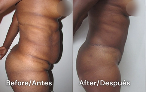 abdominoplastia en san diego