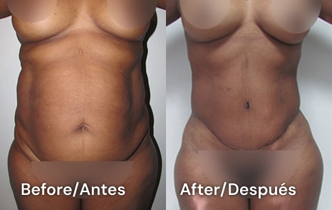 abdominoplastia en tijuana
