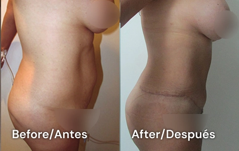abdominoplasty san diego