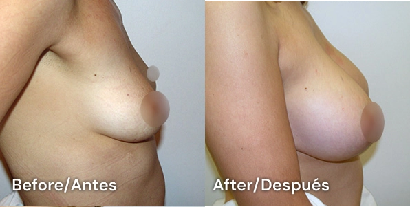 augmentation tijuana