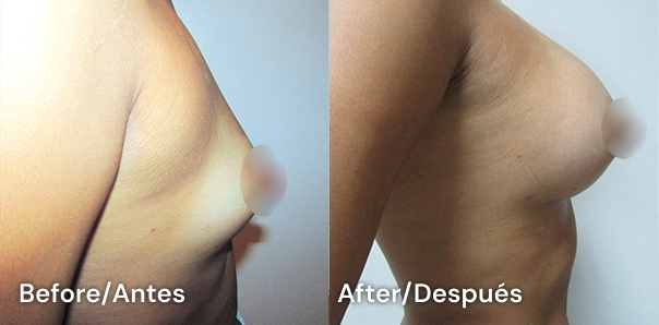 aumento de mamas en tijuana