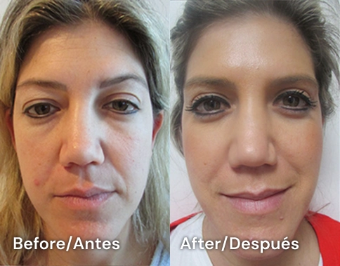 blefaroplastia en tijuana