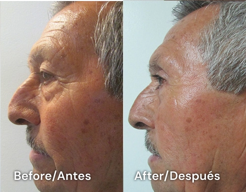 blefaroplasty san diego