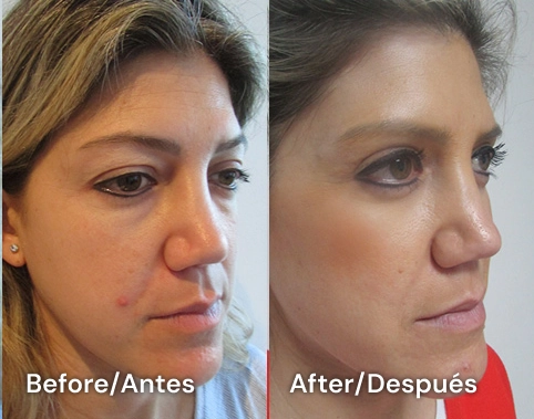 blefaroplasty tijuana