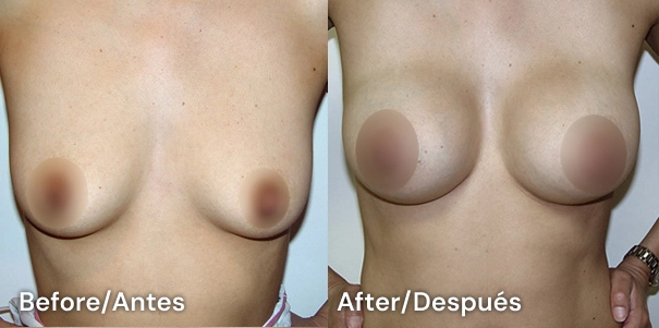 brast augmentation san diego