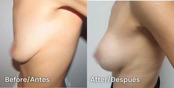 breast augmentation tijuana