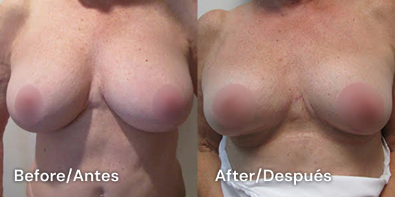 breast lift reduction tijuana