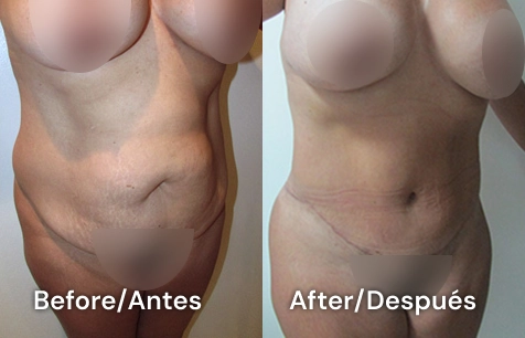 cirugía de abdomen en san diego