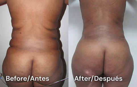 cirugia de abdomen tijuana