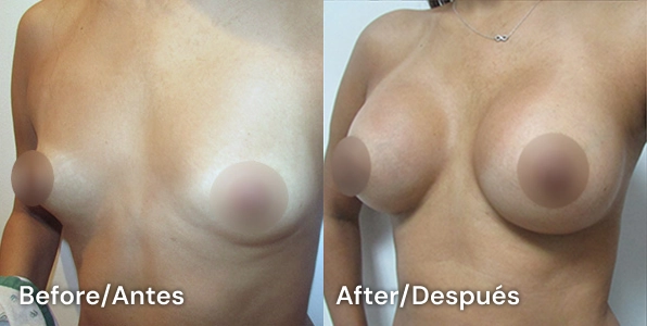 cirugia de mamas en tijuana