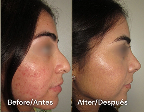 cirugia de nariz en san diego