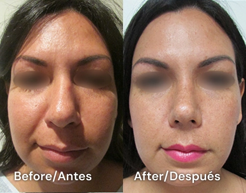 cirugia de nariz en tijuana