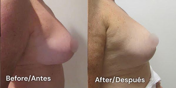 cirugía de pechos en tijuana