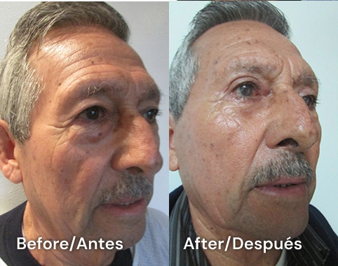 cirugia masculina de parpados en tijuana