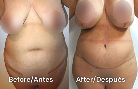 cirujano experto en abdominoplastia en tijuana