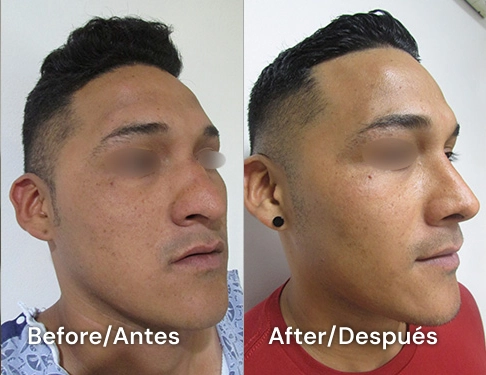 ejemplo de cirugia de narz en san diego