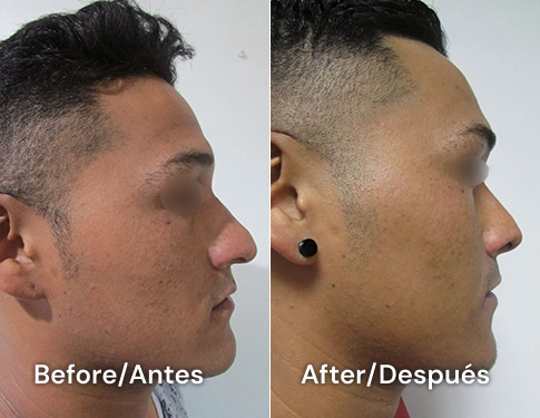 ejemplo de rinoplastia en tijuana