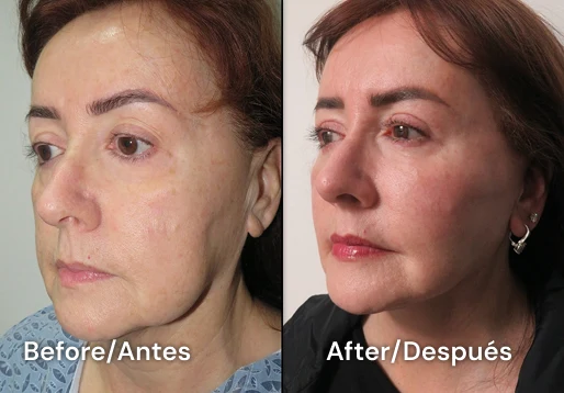 facelift tijuana 100