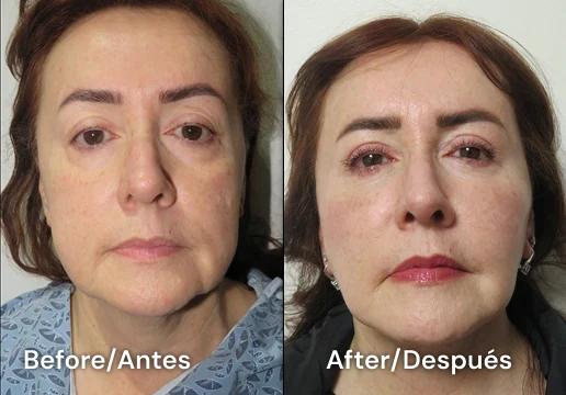 facelift tijuana 101