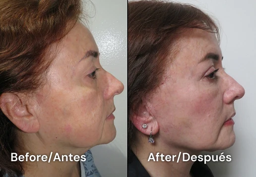 facelift tijuana 102