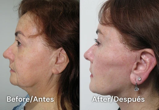 facelift tijuana 103