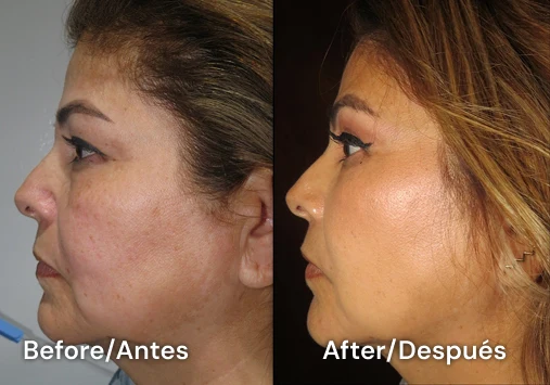 facelift tijuana 105