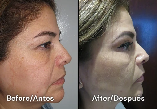 facelift tijuana 106