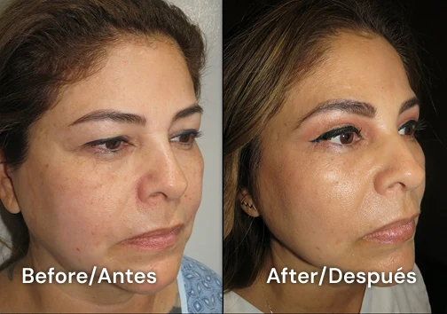 facelift tijuana 107