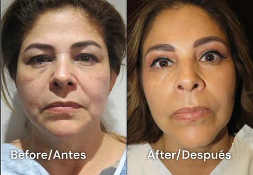 facelift tijuana 108