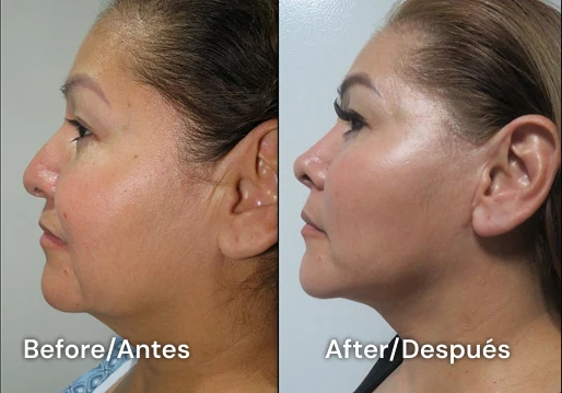 facelift tijuana 109