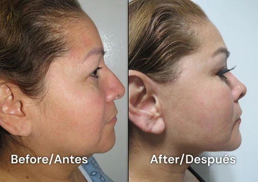 facelift tijuana 111