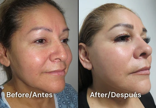 facelift tijuana 112