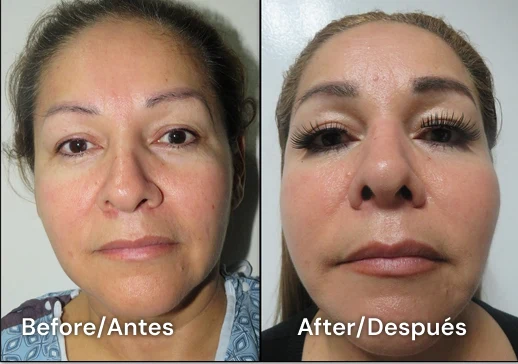 facelift tijuana 113