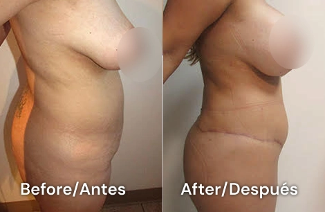 lipo de abdomen tijuana
