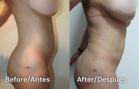 lipoescultura san diego