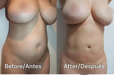 lipoescultura tijuana