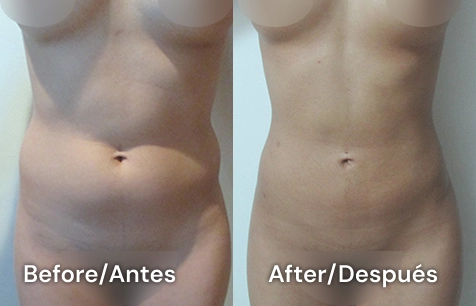 liposucción en san diego