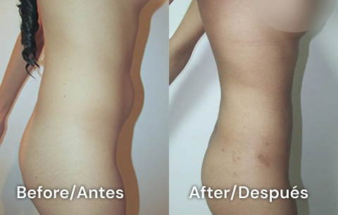 liposucción tijuana