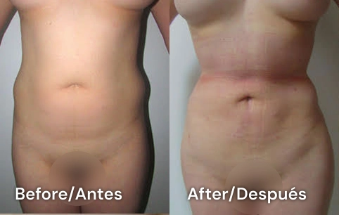 liposuction san diego