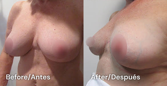 reducción de pechos en tijuana