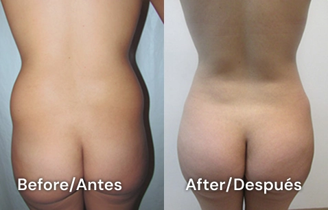 resultados de liposucción en tijuana