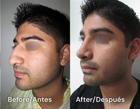 rhinoplasty san diego