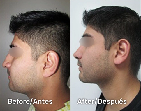 rinoplastia en san diego