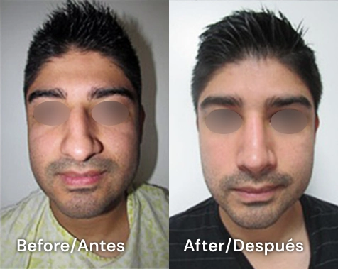 rinoplastia en tijuana