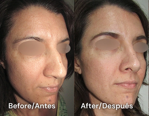 testimonial de cirugia de nariz tijuana