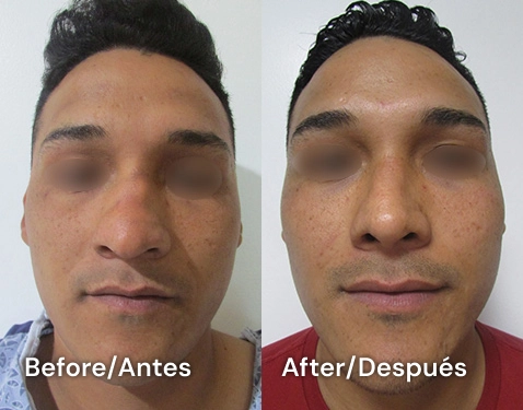 testimonial de rinoplastia en tijuana