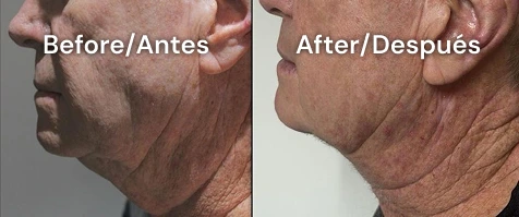 cuello plastia san diego