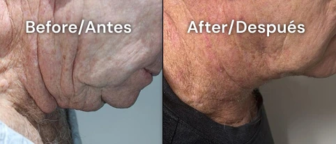cuello plastia tijuana